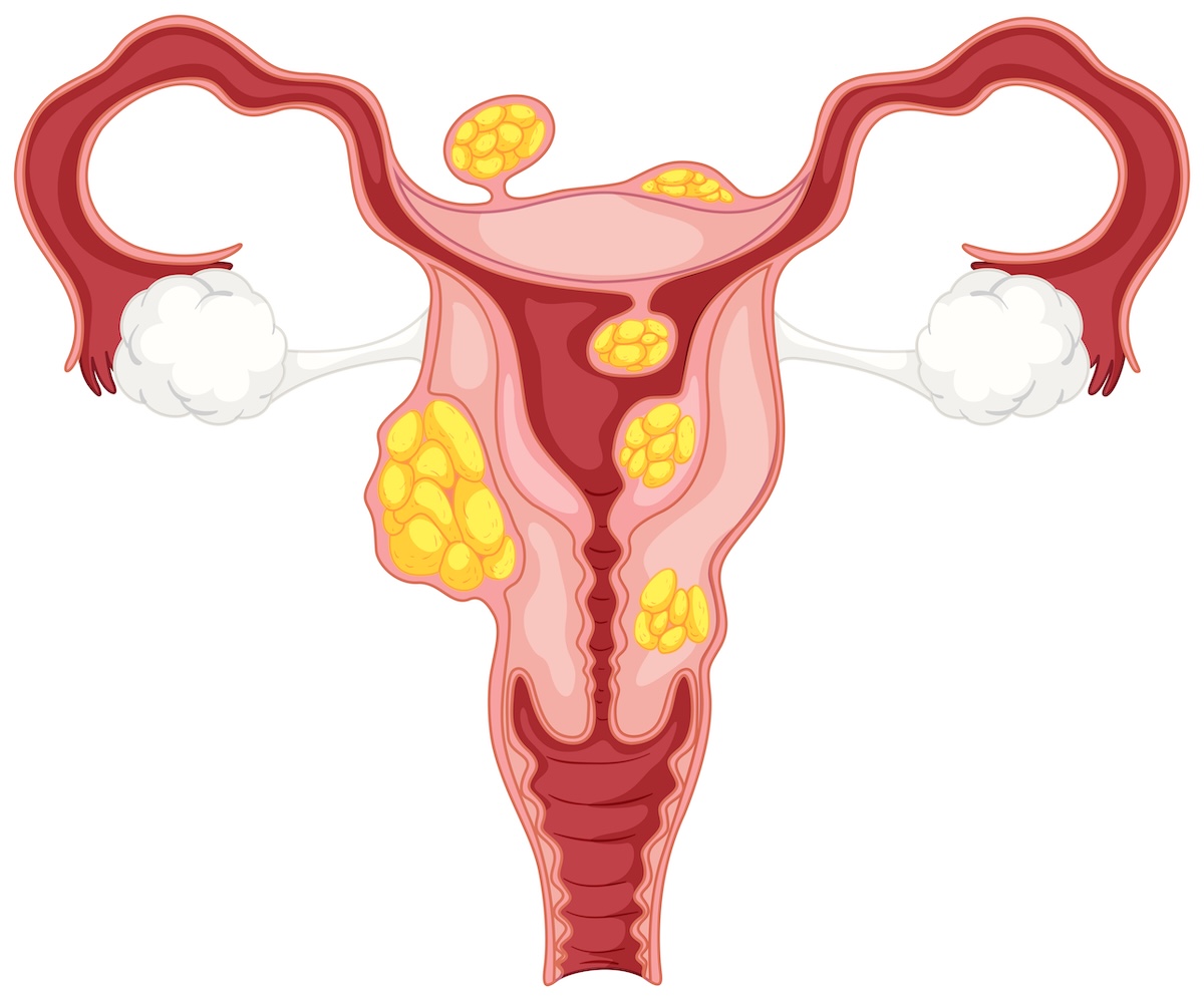 Diagram of subserosal uterine fibroids illustration - Info Vandaag