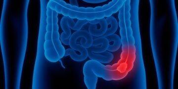 Deze klachten kunnen wijzen op darmkanker en worden vaak genegeerd