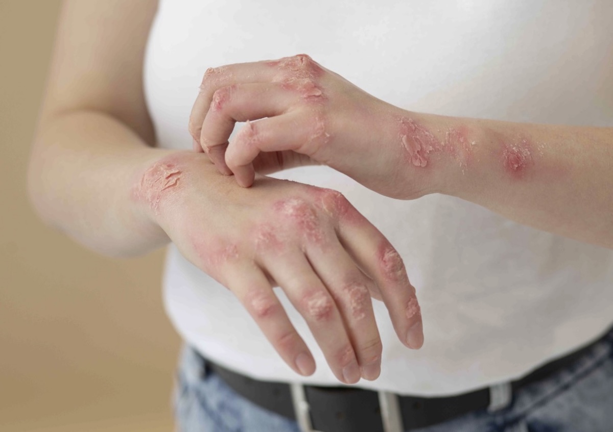 Hands with red scaly eczema patches on fingers and forearms