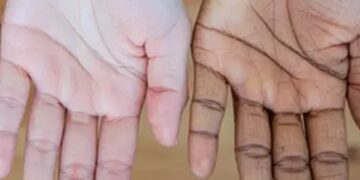 Dit verraden je handen en nagels over je lever: ga naar de huisarts als je deze 4 signalen merkt