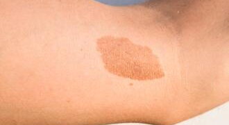 Light brown oval patch on the skin of the inner upper arm.