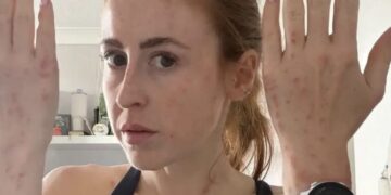 HEFTIG! Vrouw (31) doet schokkende ontdekking na hotelnacht: ‘Meer dan 100 keer gebeten’