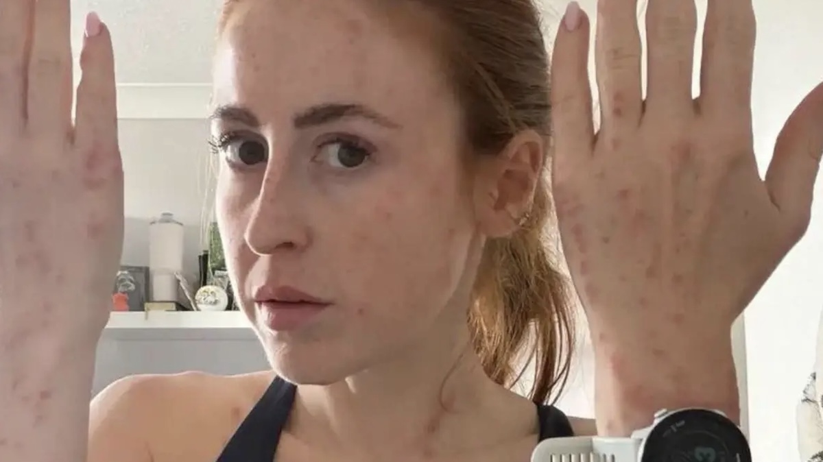 HEFTIG! Vrouw (31) doet schokkende ontdekking na hotelnacht: ‘Meer dan 100 keer gebeten’